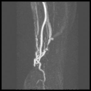 Abordaje Radial o Femoral ¿Cual es el Mejor ? Abordaje Radial o Femoral ¿Cual es el Mejor ?
