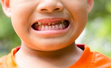 La caries dental en la infancia: la nueva epidemia