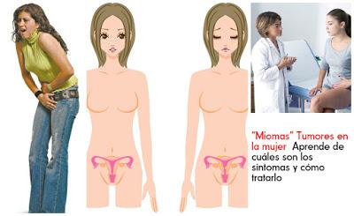 Los Miomas tumores que afectan a la mujer