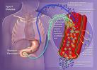 Cirugia Metabolica Cura la Diabetes Cirugia Metabolica Cura la Diabetes