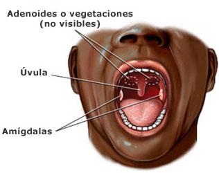 amigdalas y adenoides Amigdalectomía y el exceso de peso en los niños