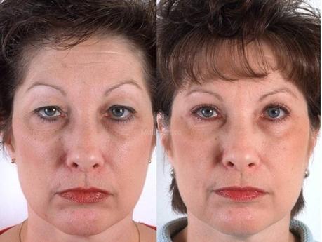 Blefaroplastia, recupera tu mirada