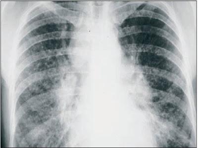 Sarcoidosis: Un diagnóstico a tener en cuenta en Atención Primaria.