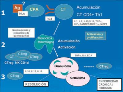 Sarcoidosis: Un diagnóstico a tener en cuenta en Atención Primaria.