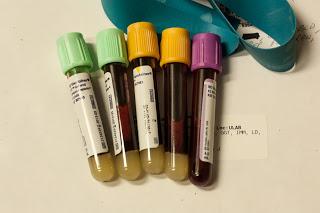 Curiosidades sobre la anemia ferropenica
