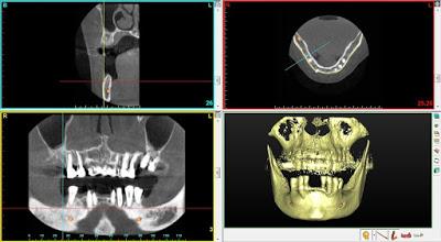 Uso de células madres y 3D para tratamientos odontológicos