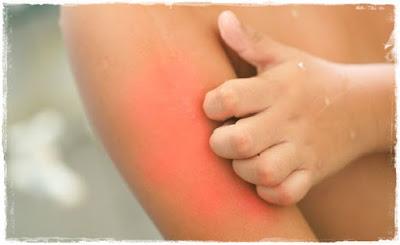 Lo que debes saber para controlar la dermatitis atópica de tu hijo