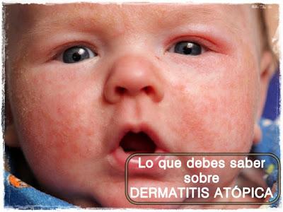 Lo que debes saber para controlar la dermatitis atópica de tu hijo