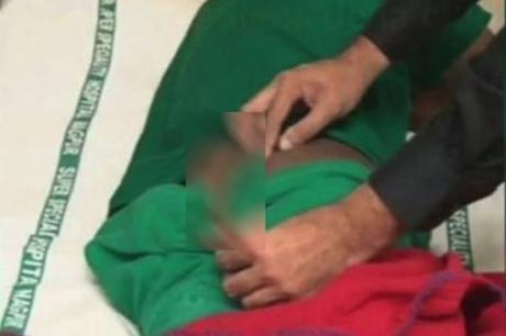 Extirpan el rabo de 18 cm de un hombre, el más largo registrado por la #medicina (FOTO Y VIDEO) Extirpan el rabo de 18 cm de un hombre, el más largo registrado por la #medicina (FOTO Y VIDEO)