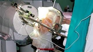 La neuroestimulación en Parkinson consigue reducir los efectos adversos La neuroestimulación en Parkinson consigue reducir los efectos adversos