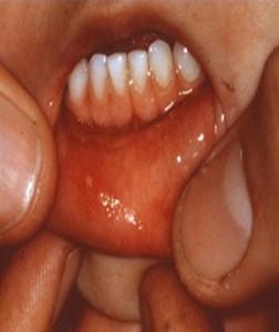 o pies manos LENGUA 252x300 Homeopatía en casos de Muguet u hongos en la boca del bebé