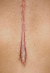 Keloid queloide 207x300 Qué son los queloides