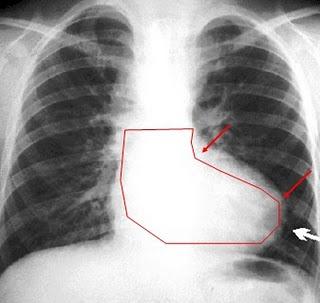 Signos radiográficos clásicos de las cardiopatías congénitas