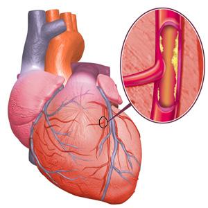 corazon-colesterol corazon colesterol Lo que se debe saber sobre el colesterol