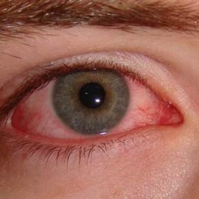 conjuntivitis-290x290 conjuntivitis 290x290 ¿Qué es la conjuntivitis?