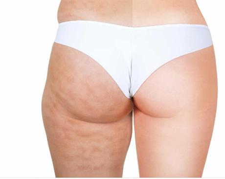 Celulitis Celulitis