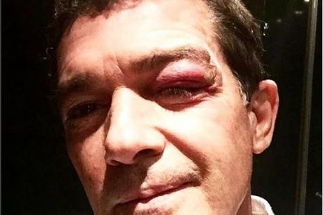 Así quedó la cara de Antonio Banderas luego de sufrir accidente (FOTO)