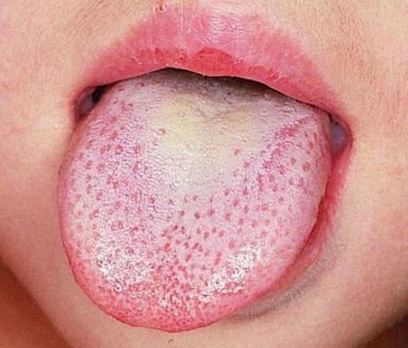 Cosas filosas y boca seca: ¿por qué? Cosas filosas y boca seca: ¿por qué?