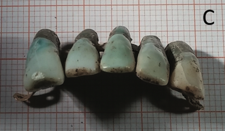 Encuentran dentadura de siglos de antiguedad hechas de dientes verdaderos The dentures were found in the tomb of a powerful family.