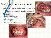 El Cancer Oral se esta Incrementando en el Mundo