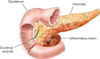 La pancreatitis crónica, ¿qué es y cómo tratarla?