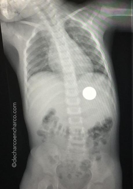 Qué pasa y cómo actuar si un niño se traga un objeto o una moneda Qué pasa y cómo actuar si un niño se traga un objeto o una moneda