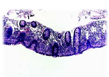 Las colitis microscópicas dentro de las enfermedades inflamatorias intestinales