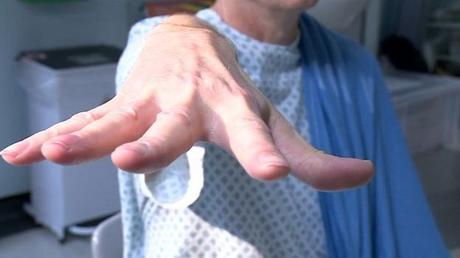 Sin bisturí ni anestesia: La increíble cirugía cerebral con ondas de sonido que curó a un paciente con temblores Sin bisturí ni anestesia: La increíble cirugía cerebral con ondas de sonido que curó a un paciente con temblores
