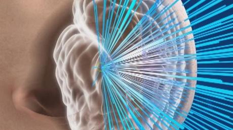 Sin bisturí ni anestesia: La increíble cirugía cerebral con ondas de sonido que curó a un paciente con temblores Sin bisturí ni anestesia: La increíble cirugía cerebral con ondas de sonido que curó a un paciente con temblores