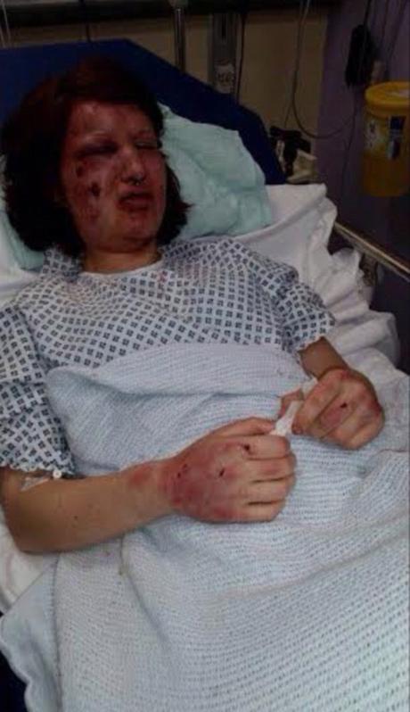 Hombre desfigura a su ex novia a mordidas para que nadie más “volviera a mirarla” (Imagenes fuertes) Hombre desfigura a su ex novia a mordidas para que nadie más “volviera a mirarla” (Imagenes fuertes)