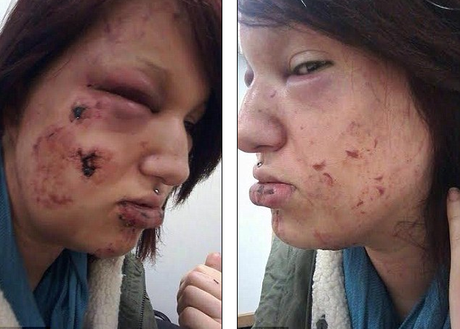 Hombre desfigura a su ex novia a mordidas para que nadie más “volviera a mirarla” (Imagenes fuertes) Hombre desfigura a su ex novia a mordidas para que nadie más “volviera a mirarla” (Imagenes fuertes)