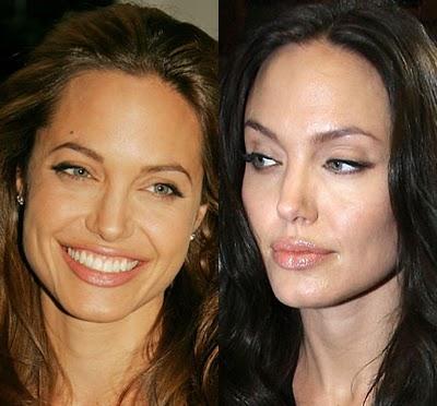 ¿Qué es el botox? ¿Qué es el botox?