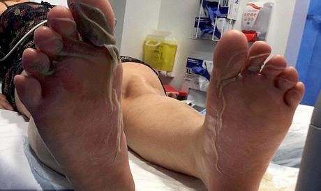 Después de ver estas imágenes lo pensarás dos veces antes de caminar descalzo en la playa pies-quemados