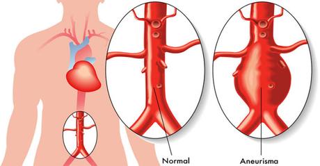 Hallan un medicamento que puede reducir la formación de aneurismas