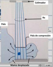 Compresión localizada: Detalle de Heywang-Kobruner S. Diagnostic Breast imaging