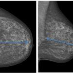 Fig 1 a y b: Mamografía.Proyección CC (a). Proyección OML (b). Posicionamiento adecuado. La distancia del pezón al pectoral debe ser similar. aaaaaaaaak