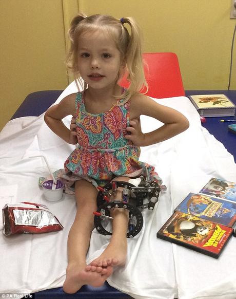 Padres eligen romper pierna de su hija tres veces al día durante cuatro meses para evitar la amputación Brave: Elsie, pictured, had her leg broken 300 times in four months - three times a day - to lengthen her left leg by more than four inches
