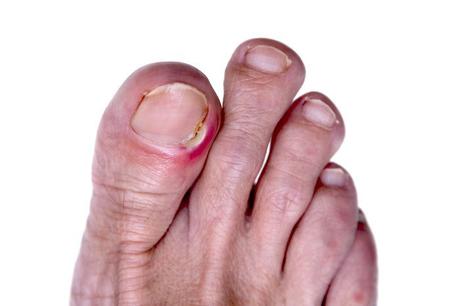 ¿Qué es una uña encarnada, y como se trata? ¿Qué es una uña encarnada, y como se trata?