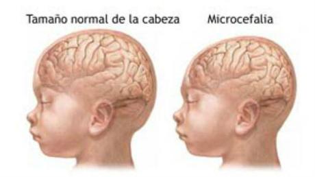 Descubren cómo el virus Zika provoca Microcefalia