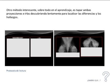 MAMOGRAFIA PROTOCOLO DE LECTURA RADIOLOGICA