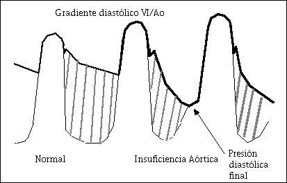 Insuficiencia aórtica Diagnóstico de la insuficiencia aórtica