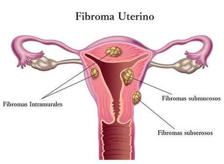 Tratamiento No Quirurgico de los Fibromas Uterinos