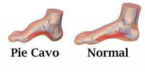 Pie cavo Síntomas de pie cavo