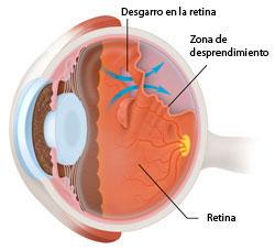 Causas del desprendimiento de retina