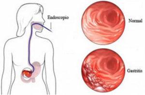 Síntomas de la gastritis aguda