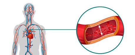 Causas de la hipertensión arterial