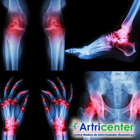 Complicaciones de la artritis reumatoide