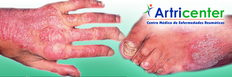 3 preguntas frecuentes de la artritis psoriásica 3 preguntas frecuentes de la artritis psoriásica