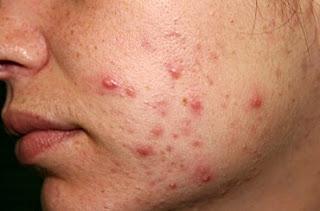 Remedios caseros para el acné