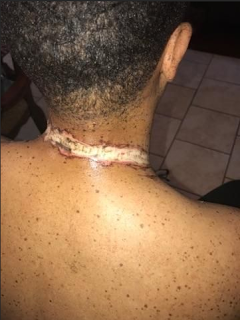 Hombre sufre severas quemaduras por dormir junto a su iPhone Hombre sufre severas quemaduras por dormir junto a su iPhone